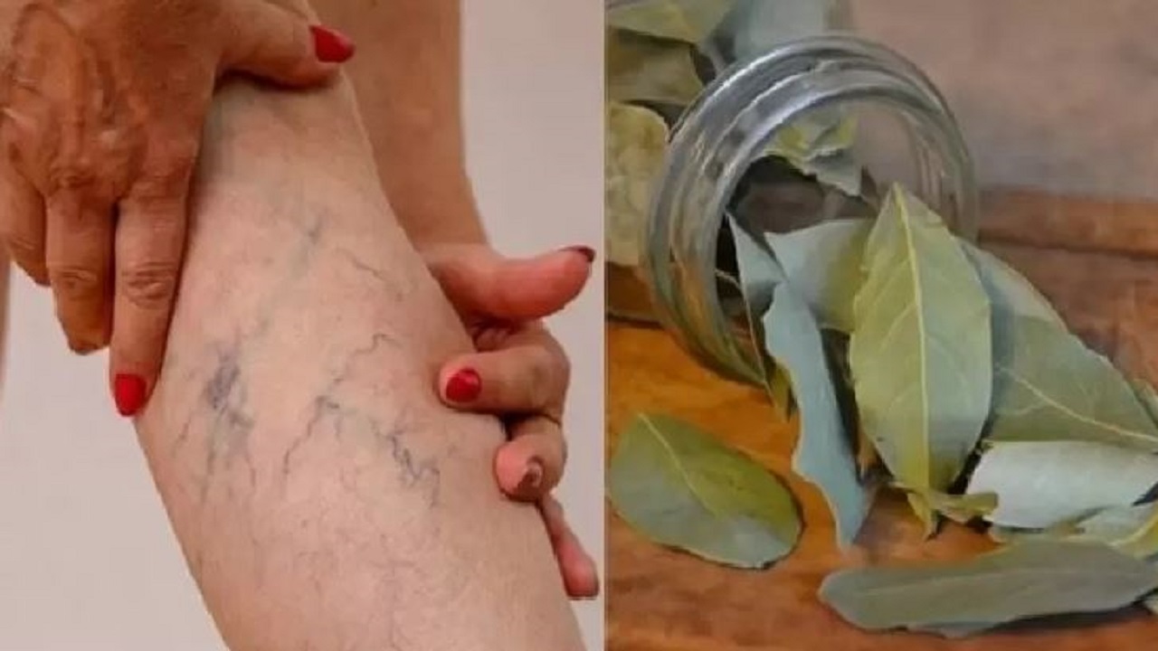 Дафинови листа срещу разширени вени